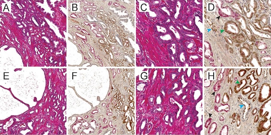 Text Box:  
Fig. 1 Detection of ERG and ETV1 on a whole-mounted sections by duplex IHC. Green, blue, and black arrowheads indicate ERG (+) prostate epithelial cells, ERG (+) endothelial cells, and ETV1 (+) prostate epithelial cells, respectively